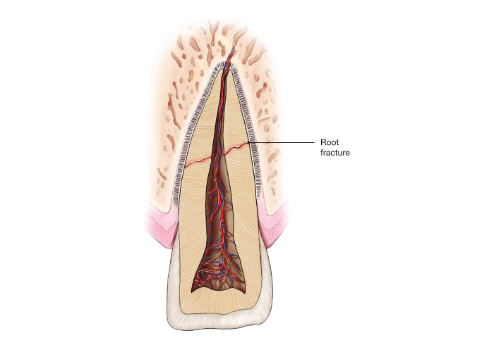 Traumatic Injury